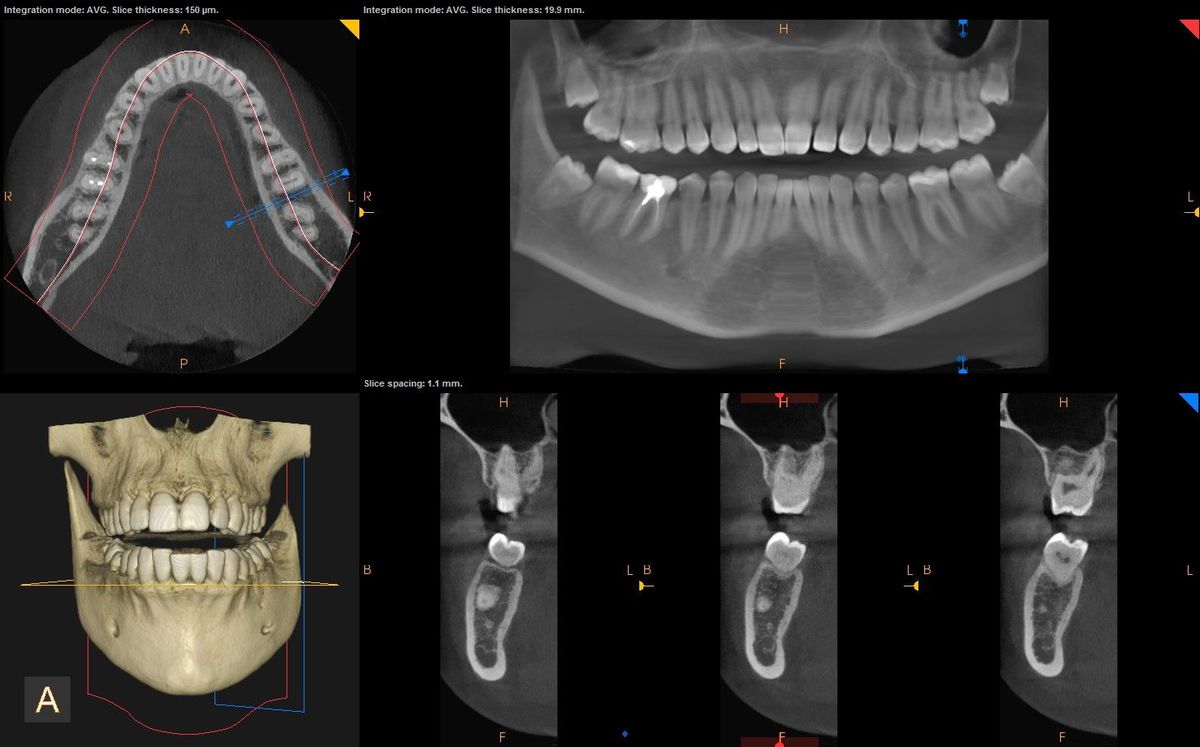 Кт д т. Кт 3d верхней и нижней челюсти. Компьютерная томография челюсти 12х8.5. Кт верхней и нижней челюсти для имплантации.